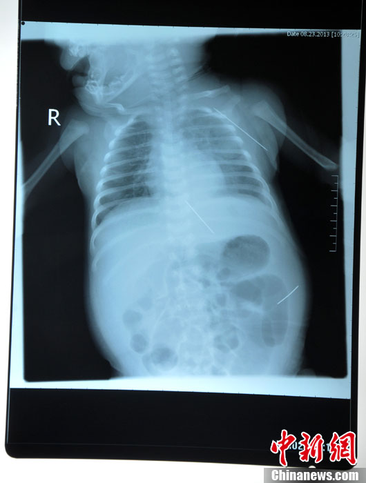 黑龍江被“縫衣針”扎傷女?huà)胧中g(shù)成功